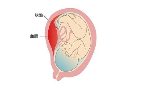 胎盤早期剝離 曲早矢